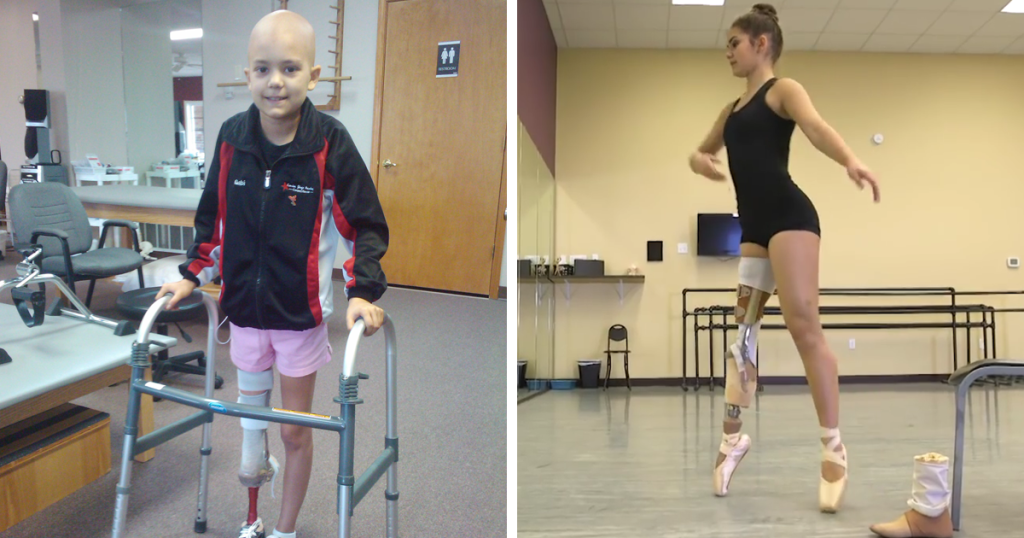 15-Year-Old Amputee Ballerina Who Lost Her Leg, Makes An Unbelievable ...